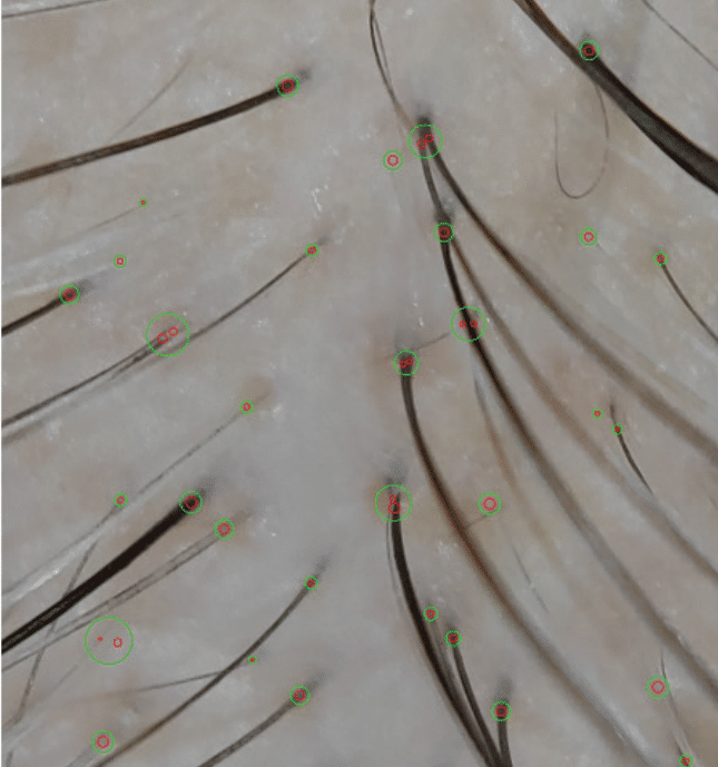 Encourages Natural Hair Regrowth: Strengthens hair follicles and promotes natural regrowth. Improves Hair Thickness and Volume: Enhances follicle health for fuller, thicker hair.