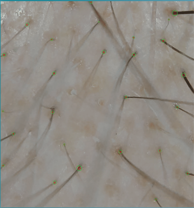 Alma TED Hair Rejuvenation – Painless, needle-free hair restoration with no post-treatment shedding
