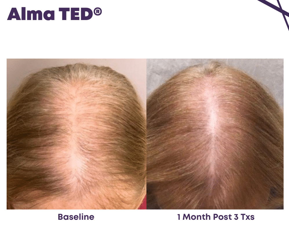 Painless Non-Invasive Hair Restoration by Alma TED, without needless and also the only hair loss treatment without the post-treatment shedding